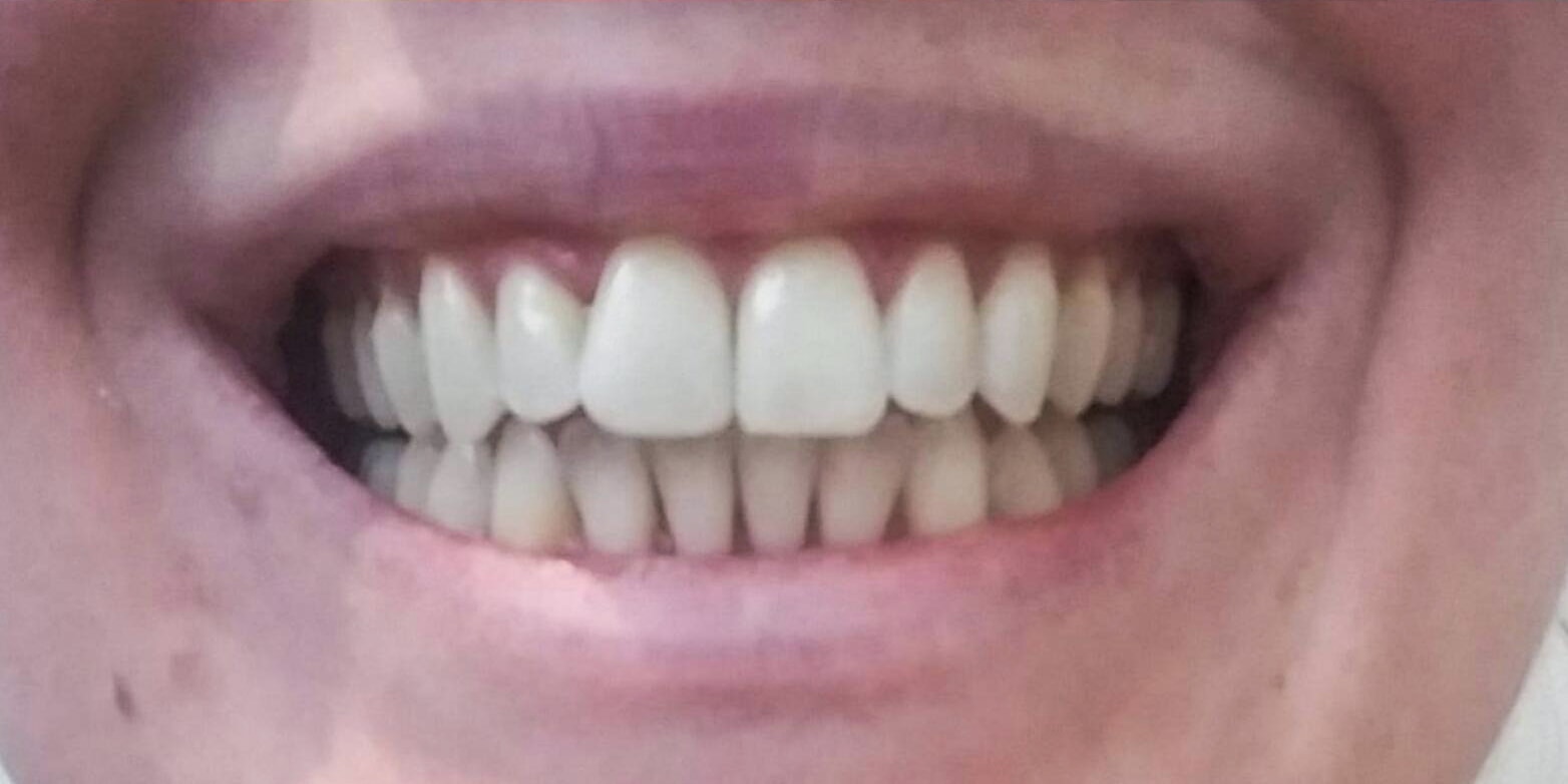 After invisalign use dentist in oshawa