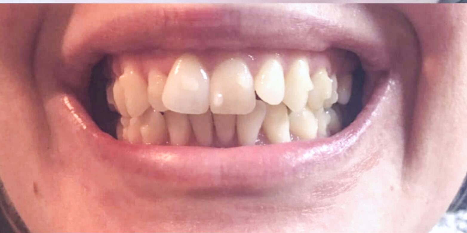 Before invisalign use